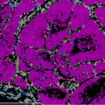 Avance en oncología: descubren el gen que activa o frena la metástasis en cáncer de mama