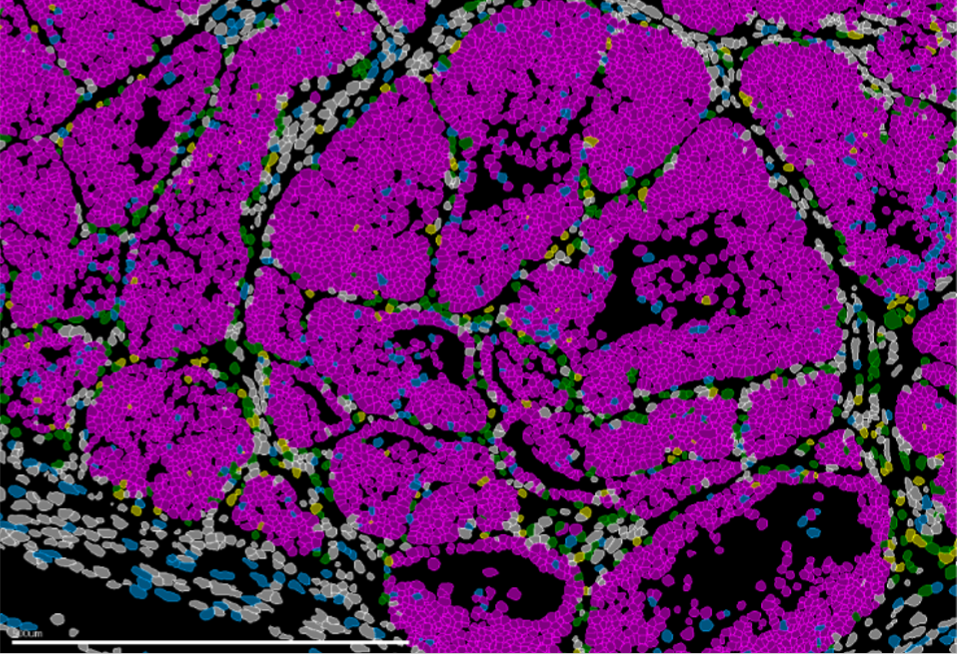 Avance en oncología: descubren el gen que activa o frena la metástasis en cáncer de mama