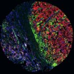 Un estudio del CSIC abre una nueva vía contra el melanoma resistente a la inmunoterapia