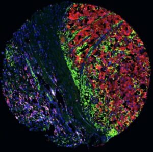 Un estudio del CSIC abre una nueva vía contra el melanoma resistente a la inmunoterapia